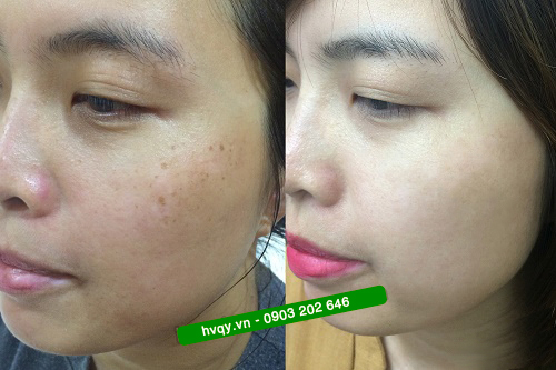 Trước và sau khi sử dụng kem dưỡng da SK Ginseng